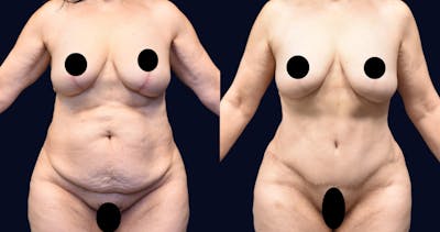 Abdominoplasty (Tummy Tuck) Before & After Gallery - Patient 210277 - Image 1