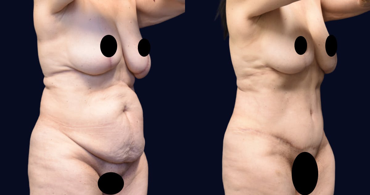 Abdominoplasty with Liposuction Before & After Gallery - Patient 269664 - Image 2