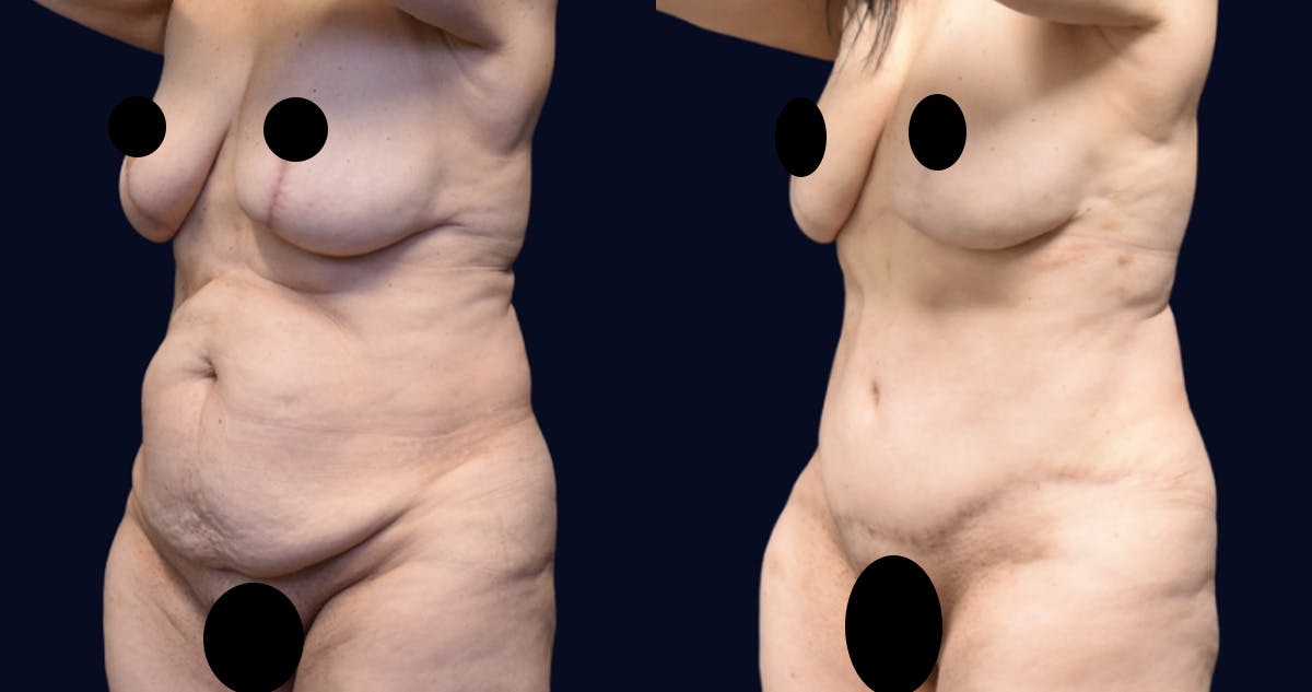 Abdominoplasty with Liposuction Before & After Gallery - Patient 269664 - Image 3