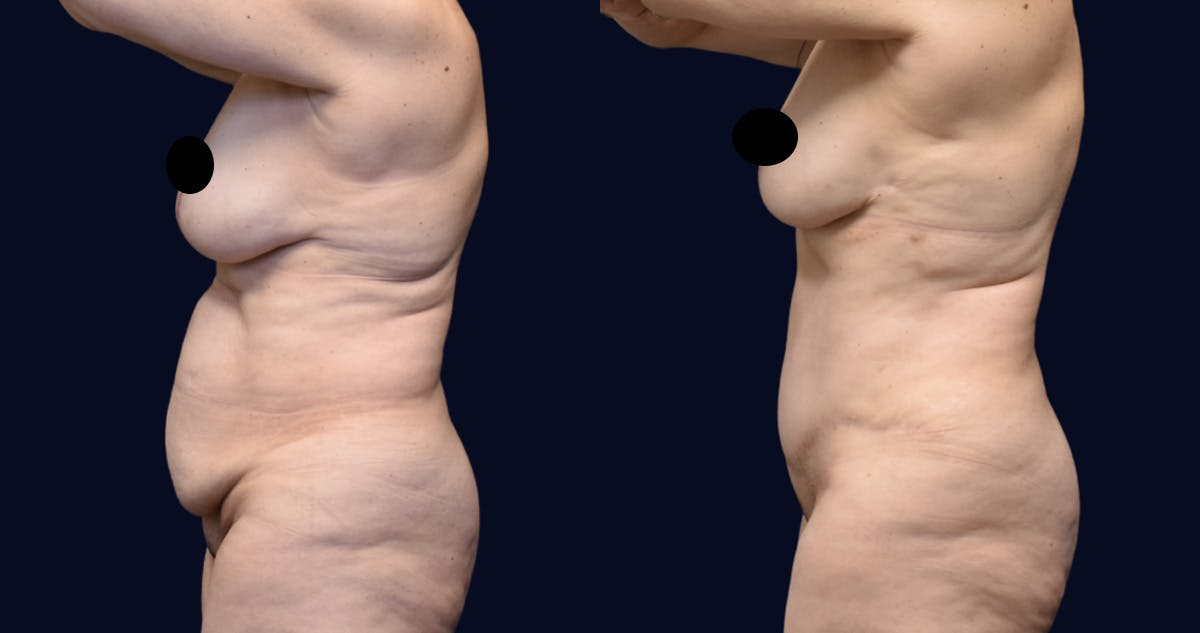 Abdominoplasty with Liposuction Before & After Gallery - Patient 269664 - Image 4