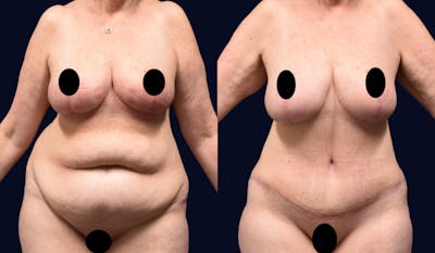 Abdominoplasty with Liposuction Before & After Gallery - Patient 289470 - Image 1
