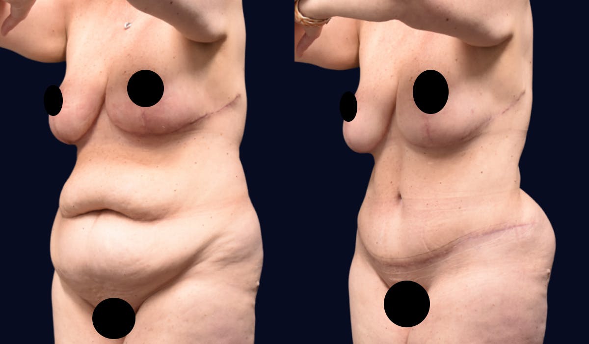 Abdominoplasty with Liposuction Before & After Gallery - Patient 289470 - Image 2