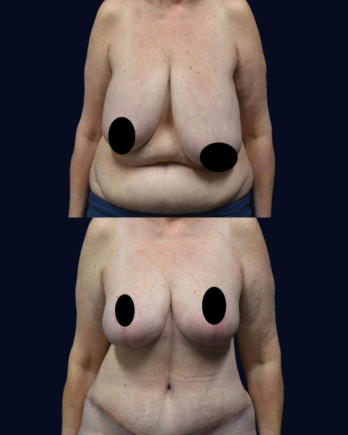 Breast Reduction and Lift Before & After Gallery - Patient 232097 - Image 1