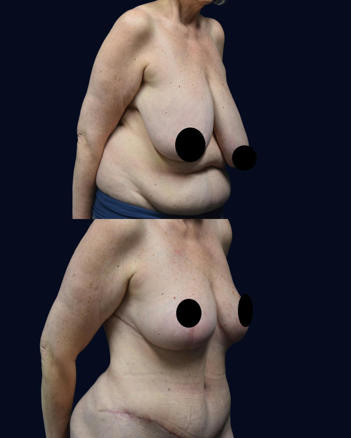 Breast Reduction and Lift Before & After Gallery - Patient 232097 - Image 2