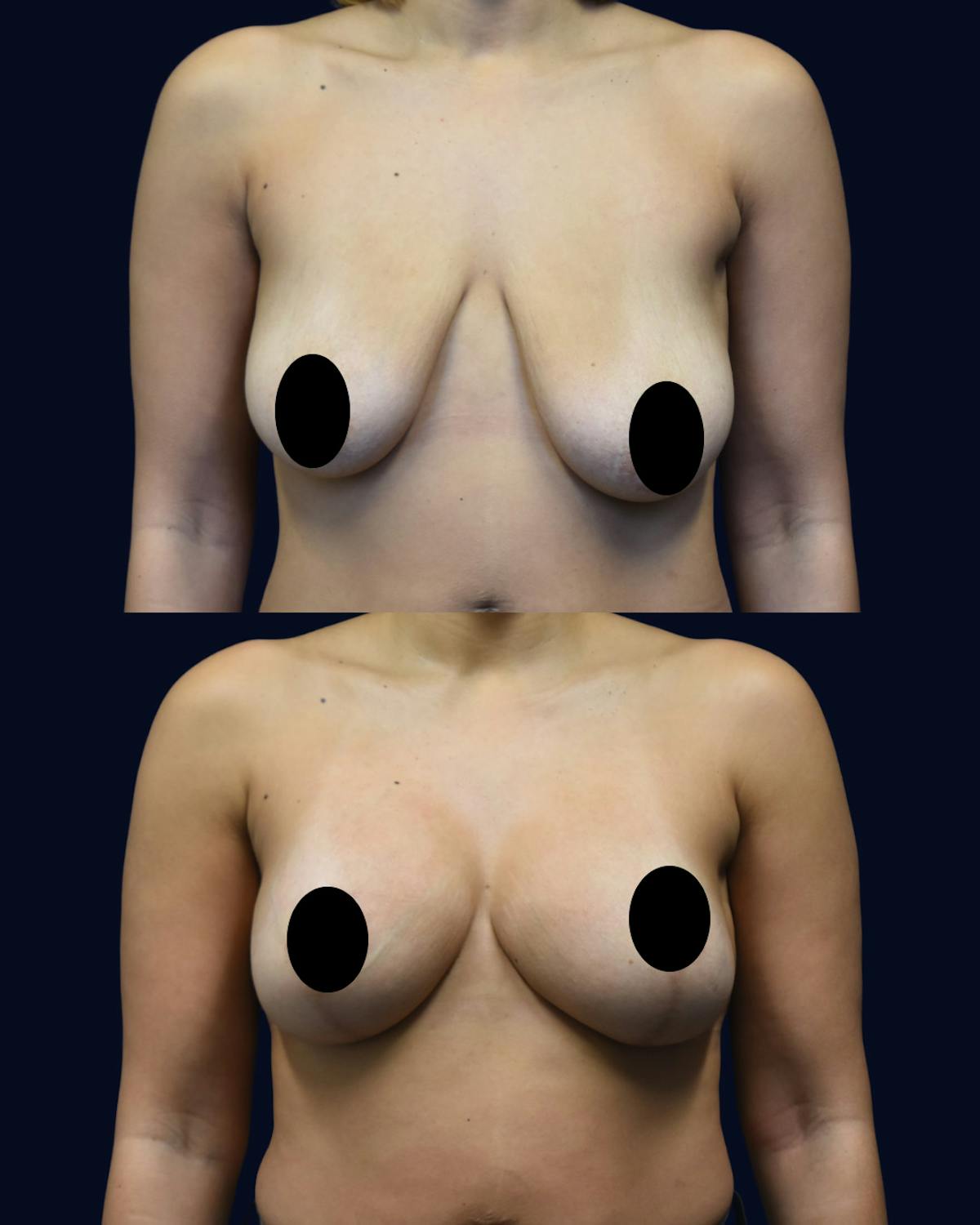 Breast Reduction and Lift Before & After Gallery - Patient 232531 - Image 1