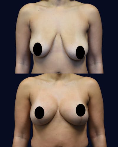 Breast Reduction and Lift Before & After Gallery - Patient 232531 - Image 1