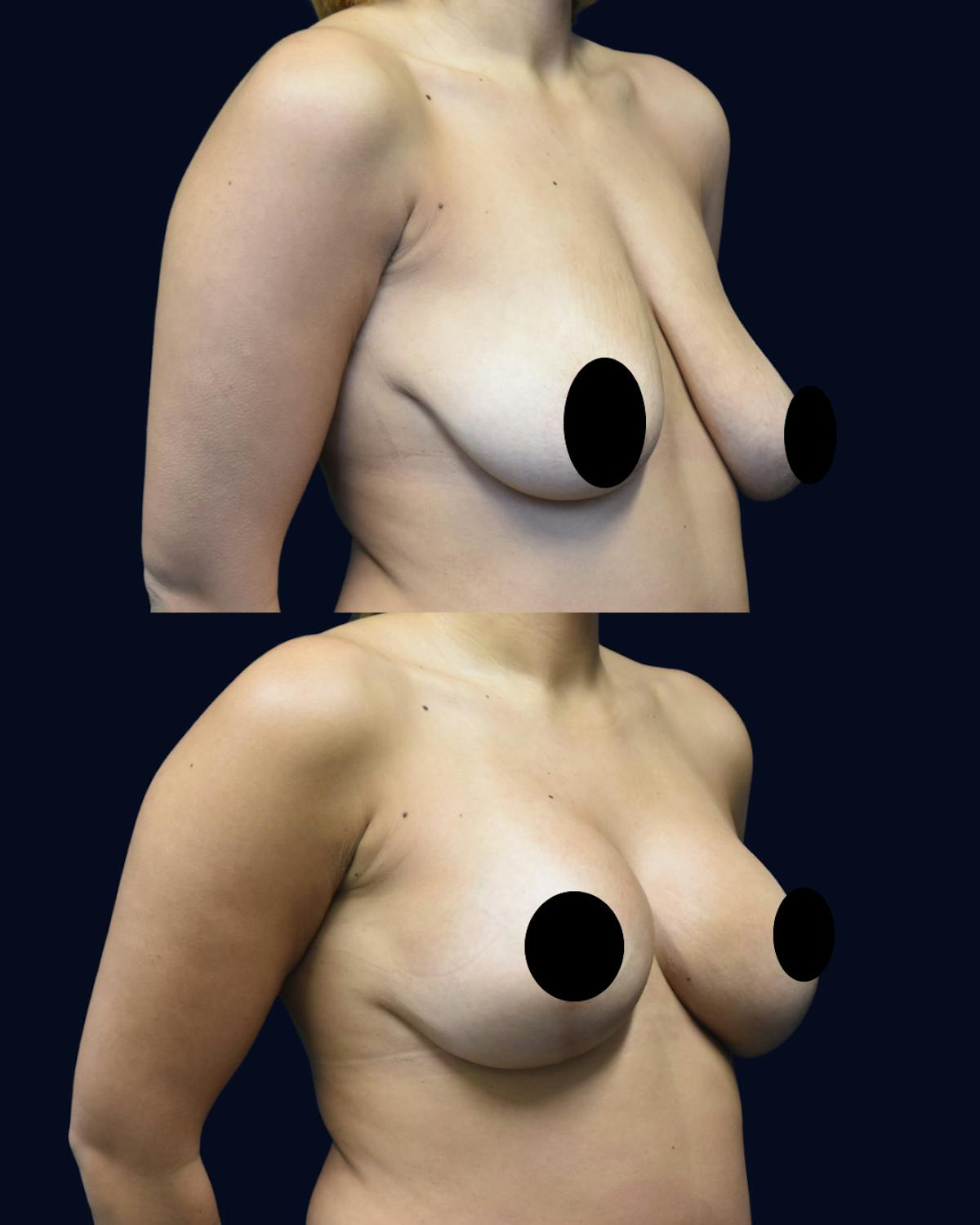 Breast Reduction and Lift Before & After Gallery - Patient 232531 - Image 2