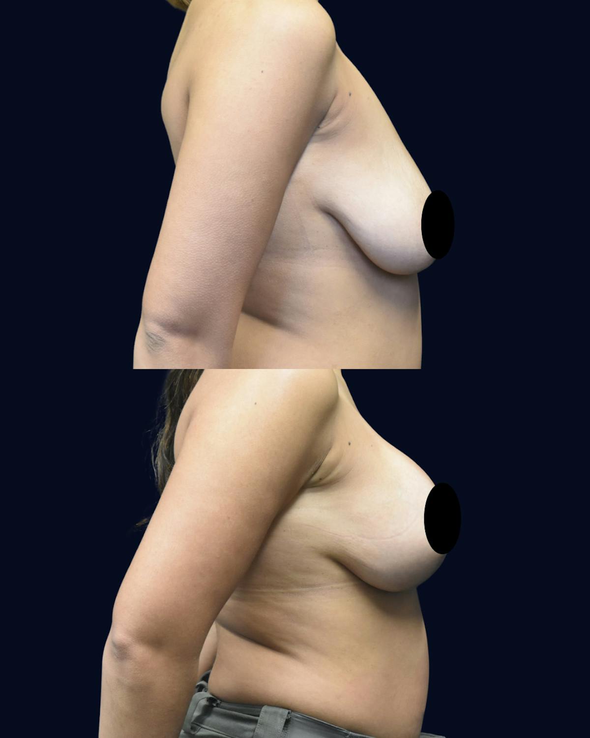 Breast Reduction and Lift Before & After Gallery - Patient 232531 - Image 3