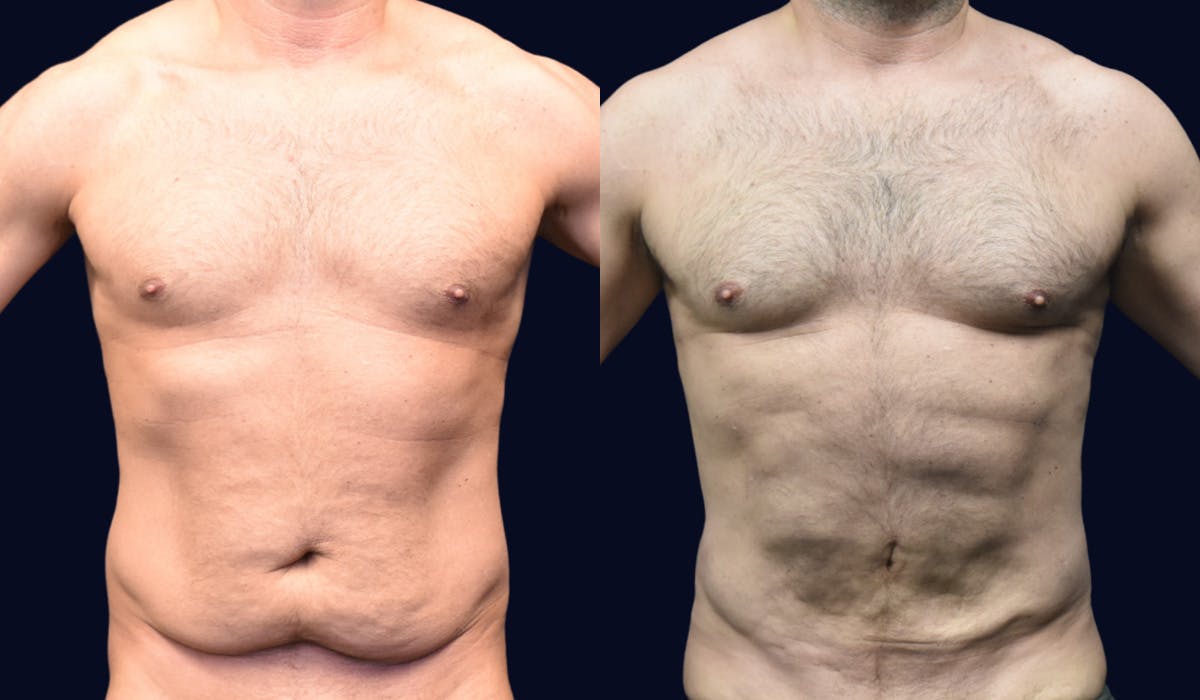 Liposuction Before & After Gallery - Patient 121645 - Image 1