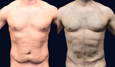 Liposuction Before & After Gallery - Patient 121645 - Image 1