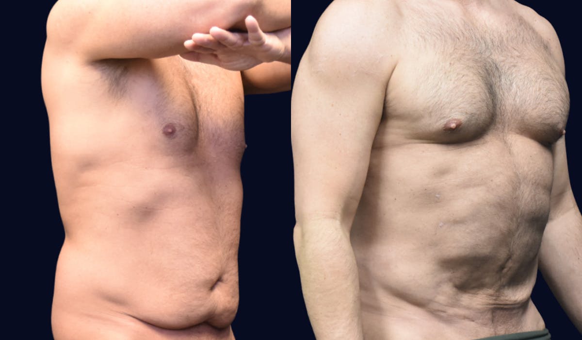 Liposuction Before & After Gallery - Patient 121645 - Image 2