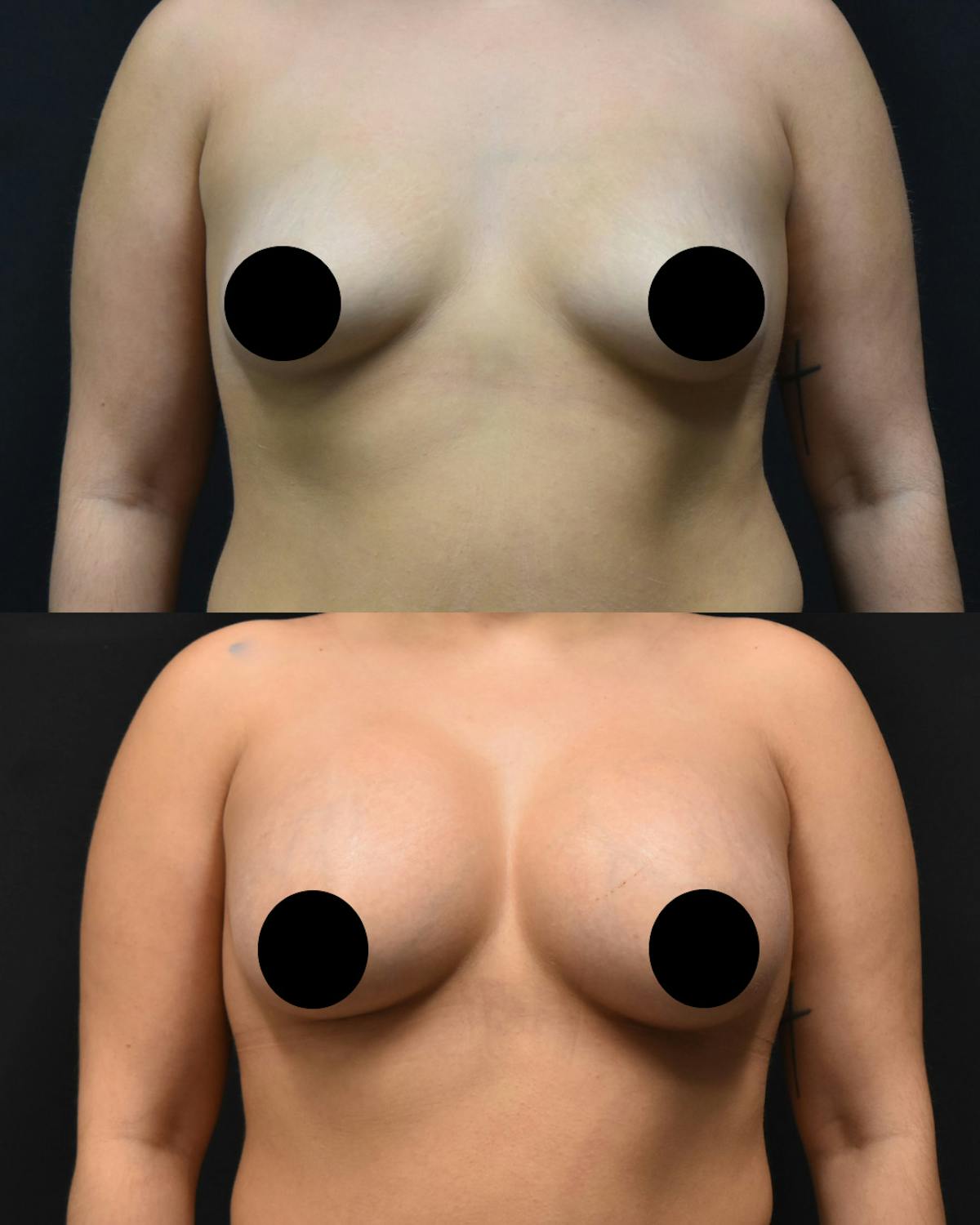 Breast Augmentation Before & After Gallery - Patient 685777 - Image 1