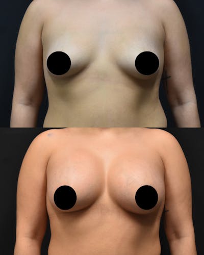 Breast Augmentation Before & After Gallery - Patient 685777 - Image 1