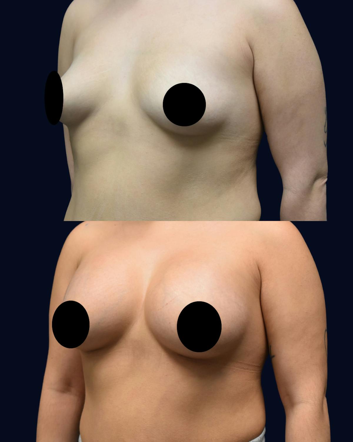 Breast Augmentation Before & After Gallery - Patient 685777 - Image 2