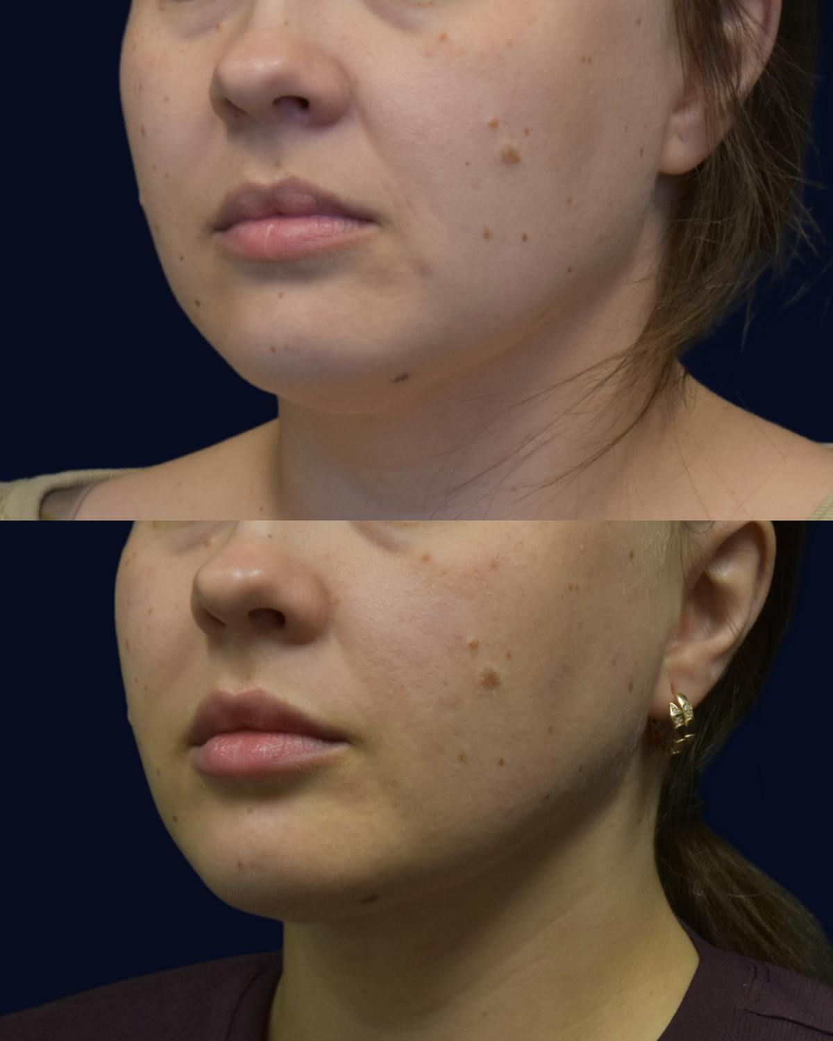 Facial Liposuction Before & After Gallery - Patient 176622 - Image 1