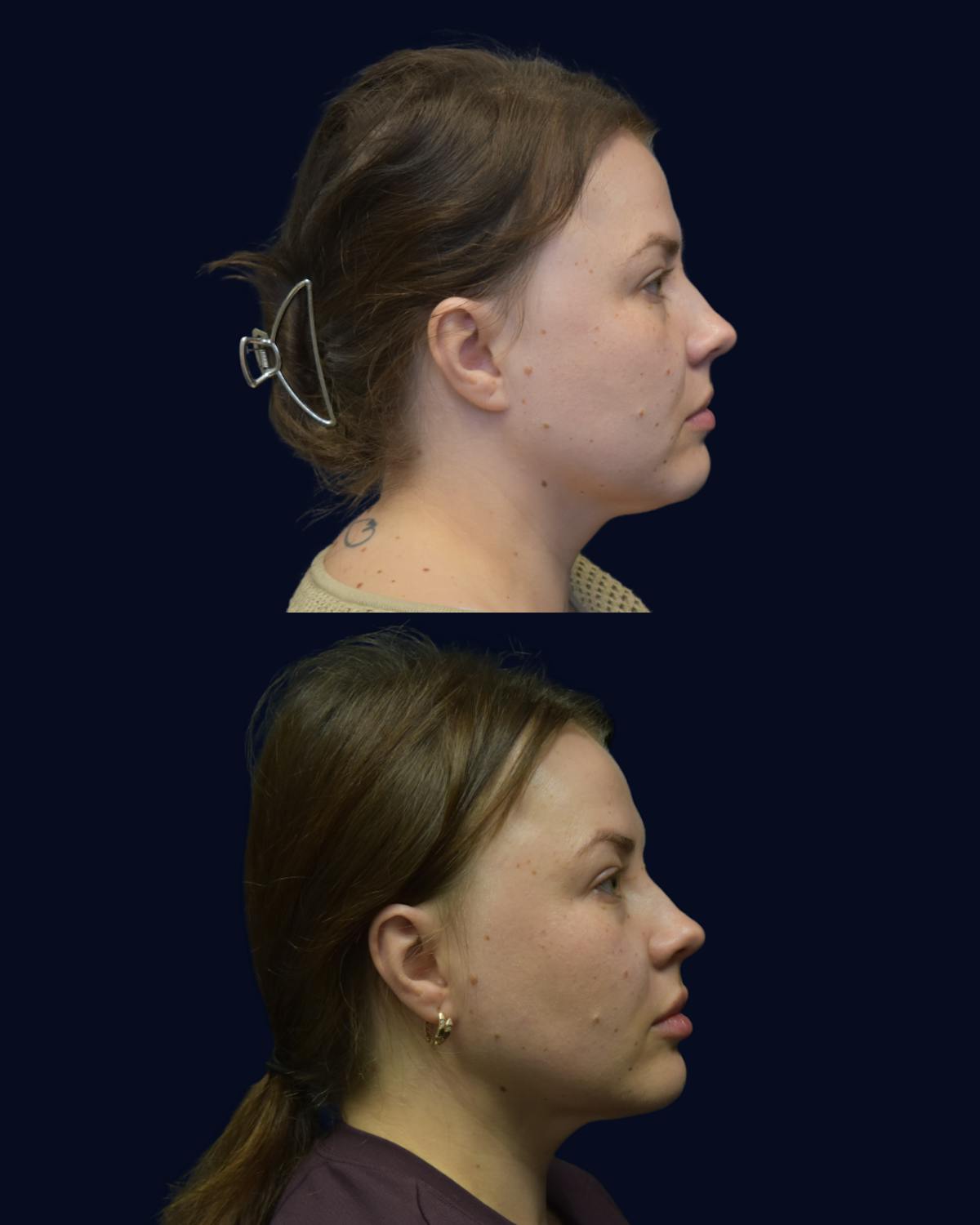 Facial Liposuction Before & After Gallery - Patient 176622 - Image 2
