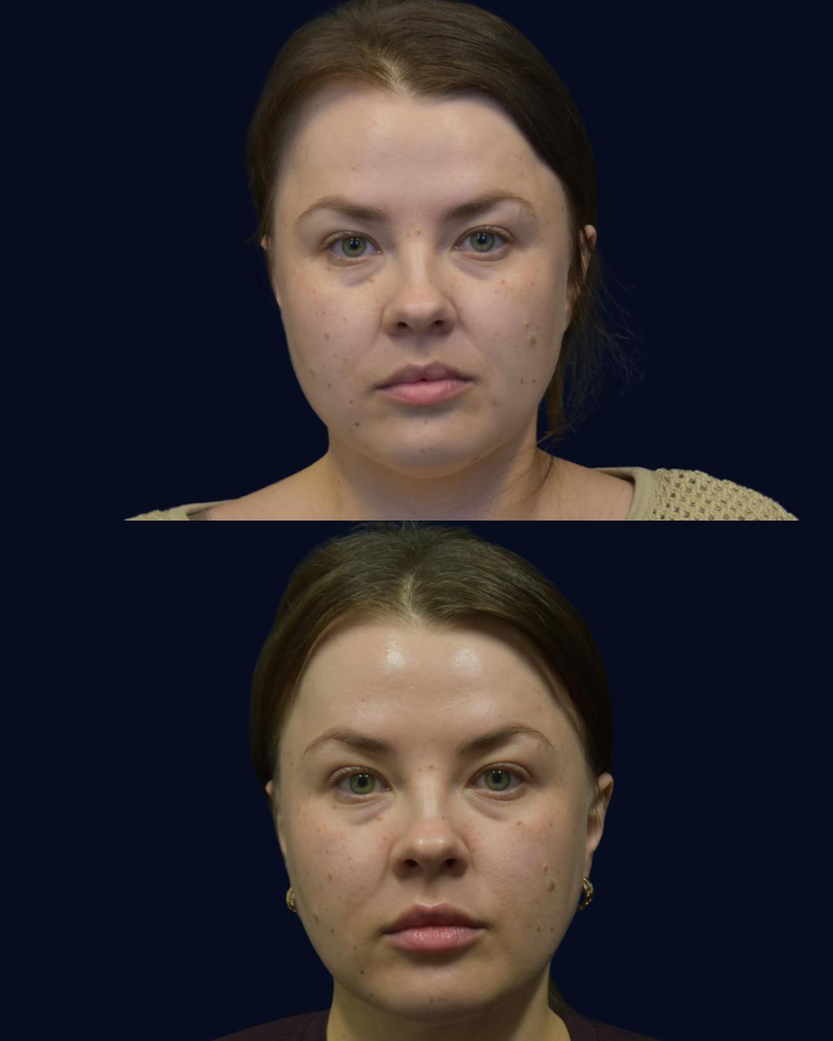 Facial Liposuction Before & After Gallery - Patient 176622 - Image 3