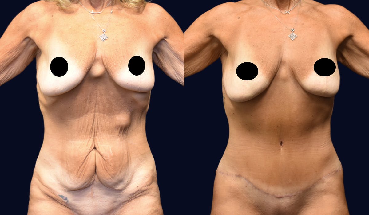 Abdominoplasty (Tummy Tuck) Before & After Gallery - Patient 304007 - Image 1