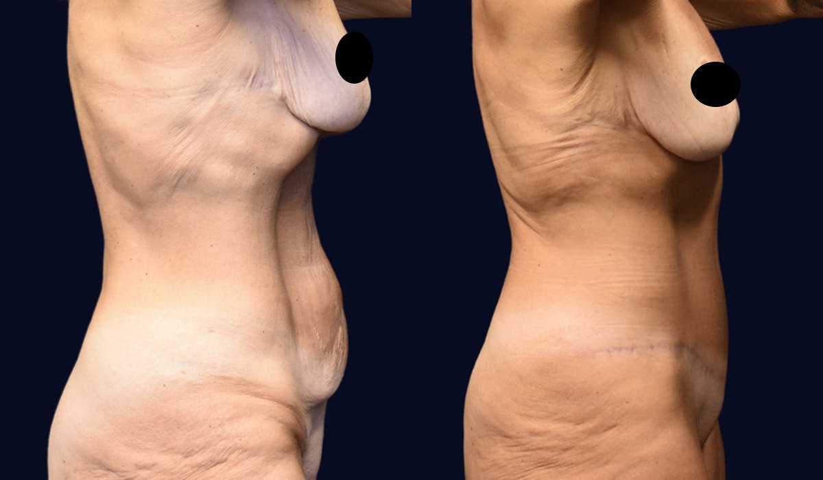 Abdominoplasty (Tummy Tuck) Before & After Gallery - Patient 304007 - Image 3