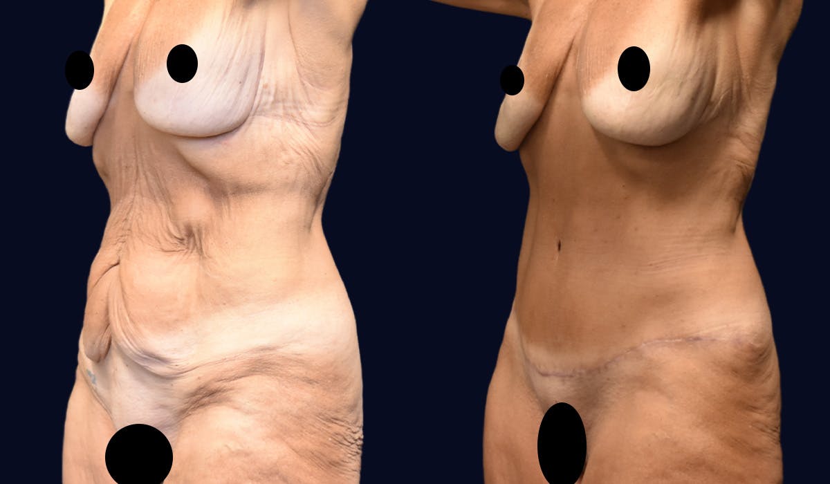 Abdominoplasty (Tummy Tuck) Before & After Gallery - Patient 304007 - Image 2