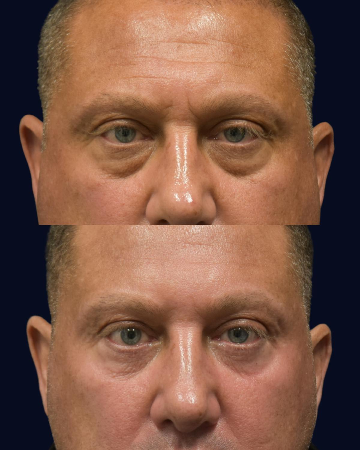 Blepharoplasty (Eyelid Surgery) Before & After Gallery - Patient 320040 - Image 1