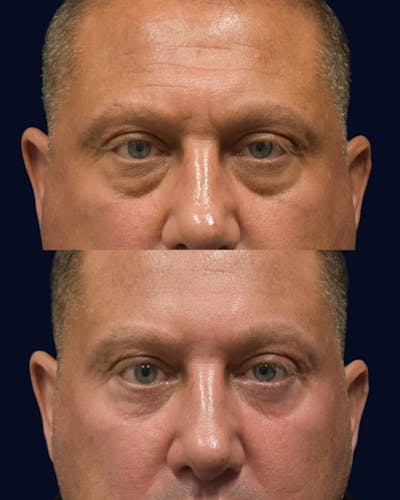 Blepharoplasty (Eyelid Surgery) Before & After Gallery - Patient 320040 - Image 1