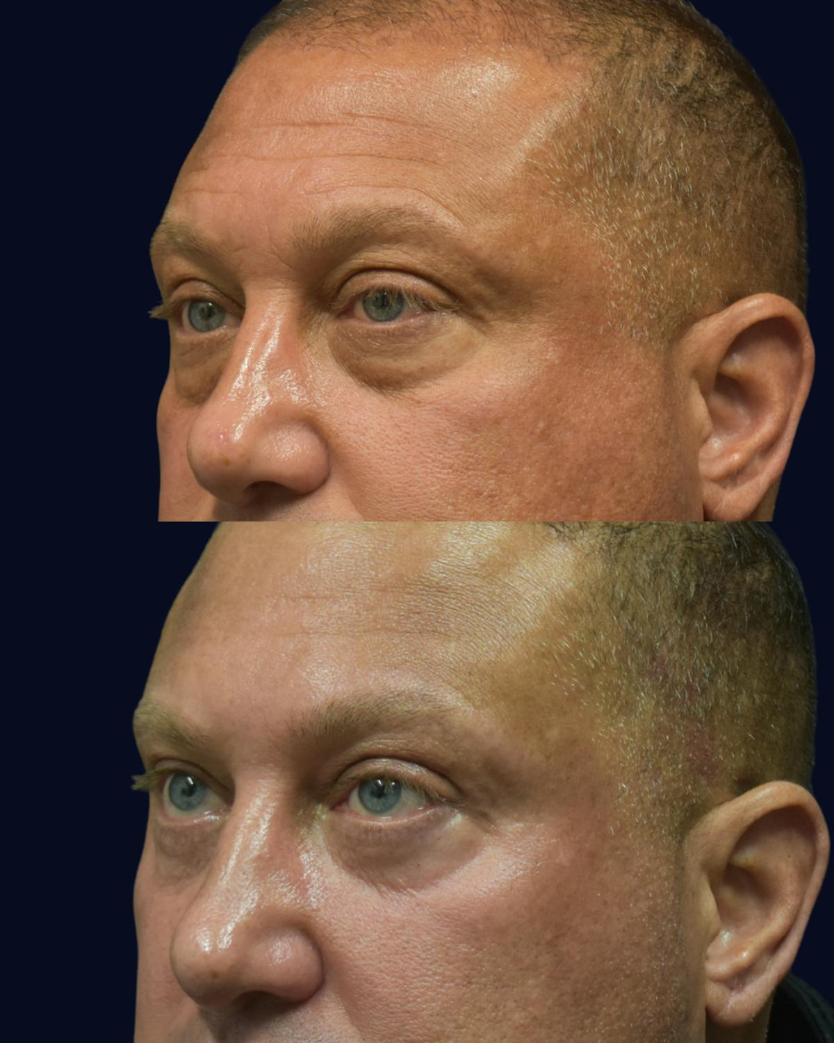 Blepharoplasty (Eyelid Surgery) Before & After Gallery - Patient 320040 - Image 3