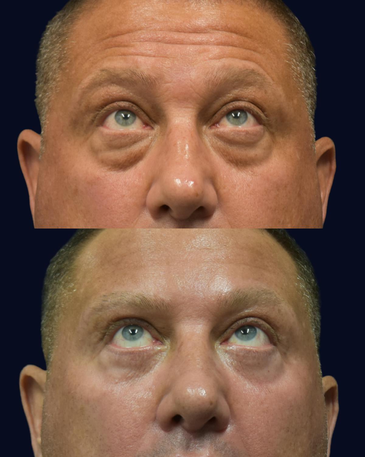 Blepharoplasty (Eyelid Surgery) Before & After Gallery - Patient 320040 - Image 2