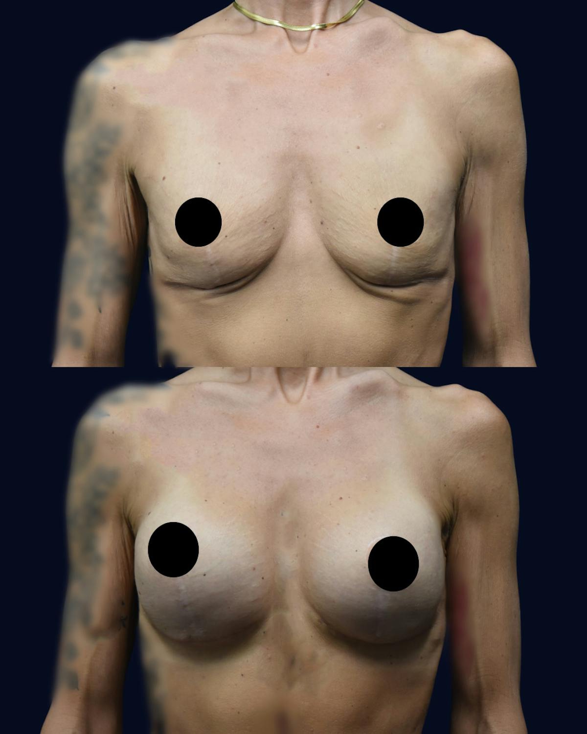 Breast Augmentation Before & After Gallery - Patient 554191 - Image 1