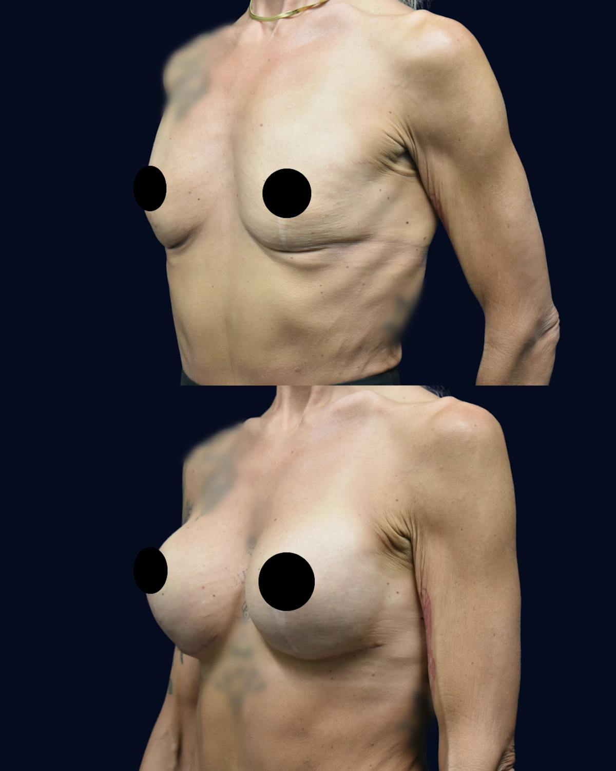 Breast Augmentation Before & After Gallery - Patient 554191 - Image 2