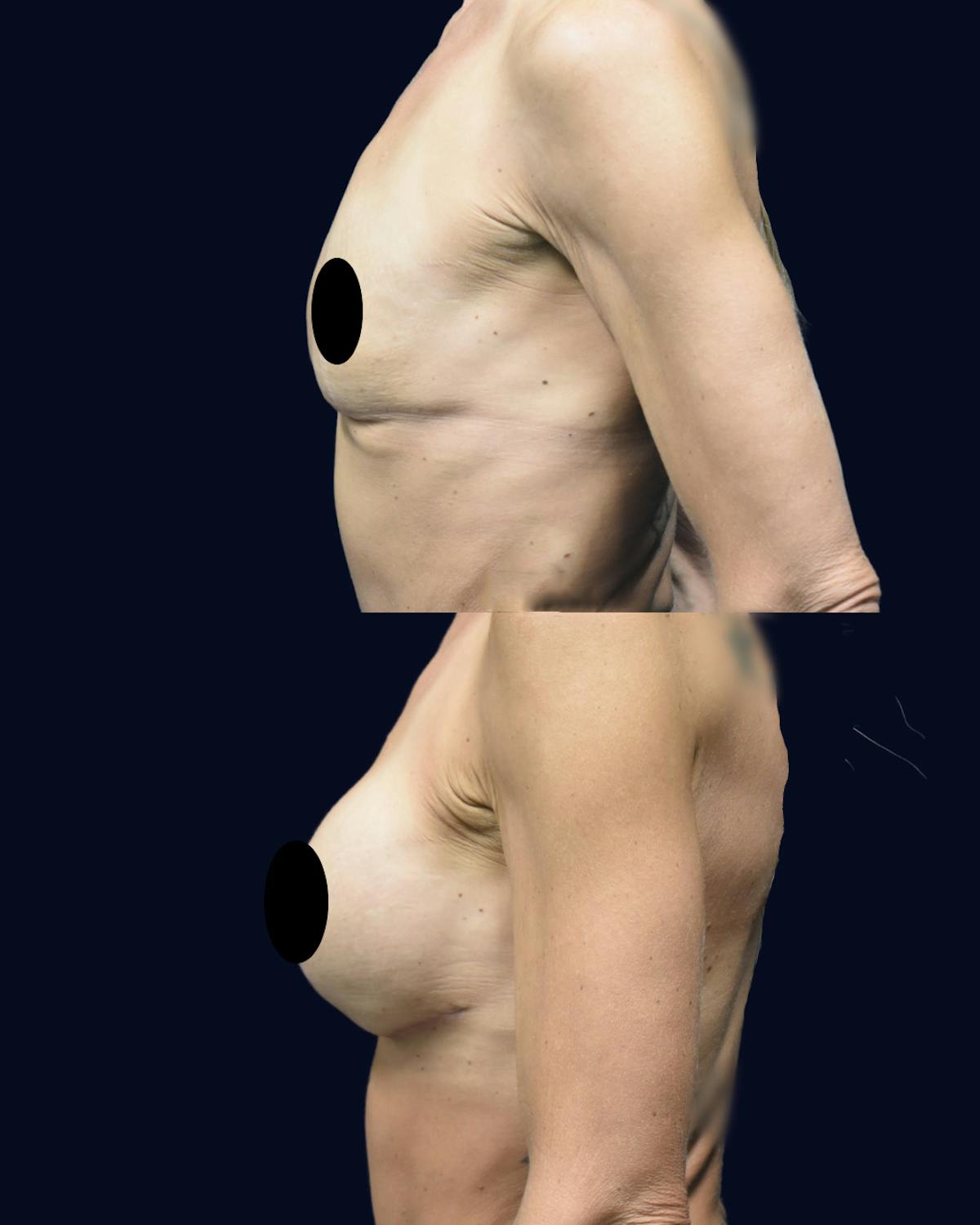 Breast Augmentation Before & After Gallery - Patient 554191 - Image 3