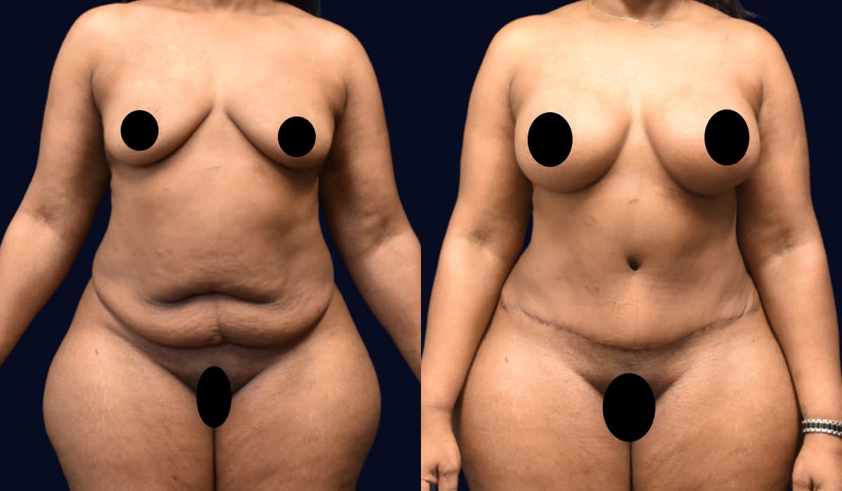 Abdominoplasty (Tummy Tuck) Before & After Gallery - Patient 101439 - Image 1