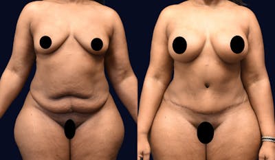 Abdominoplasty (Tummy Tuck) Before & After Gallery - Patient 101439 - Image 1