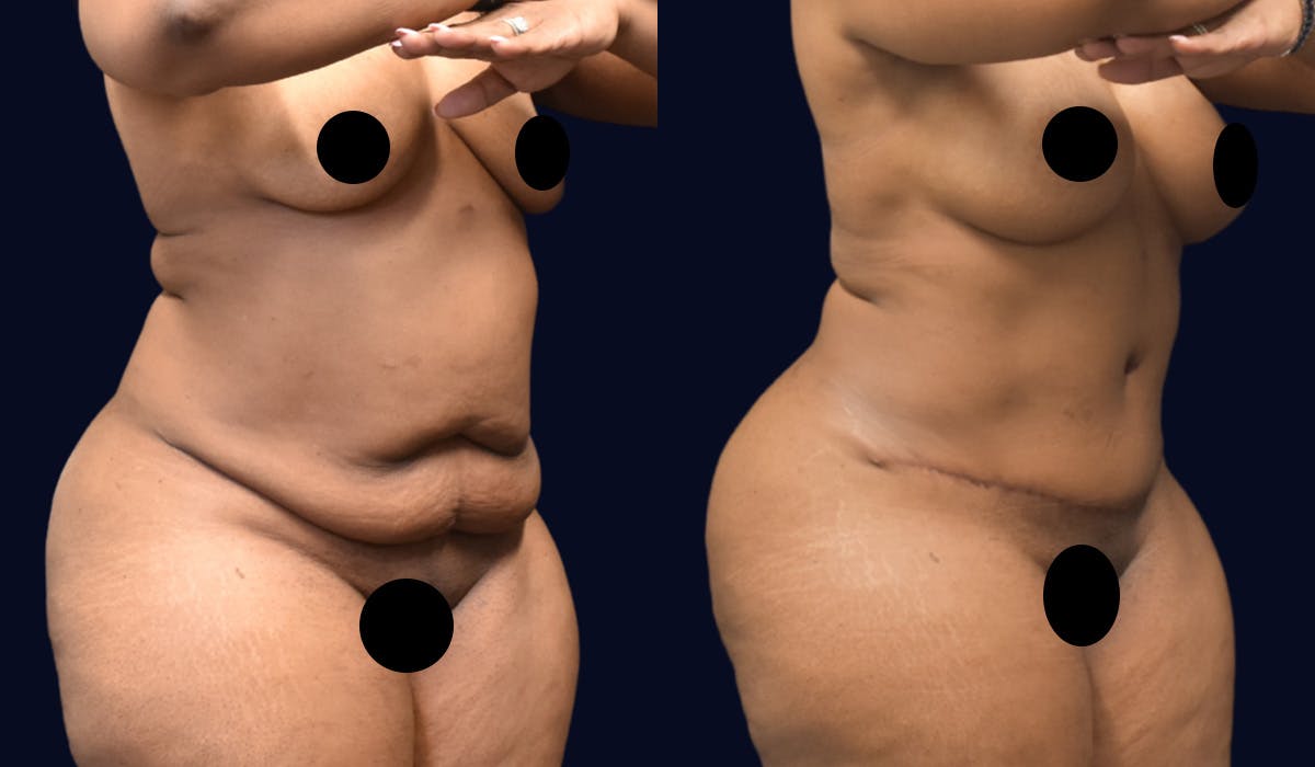 Abdominoplasty (Tummy Tuck) Before & After Gallery - Patient 101439 - Image 2
