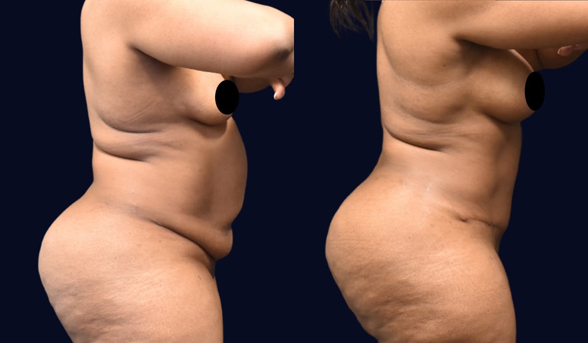 Abdominoplasty (Tummy Tuck) Before & After Gallery - Patient 101439 - Image 3