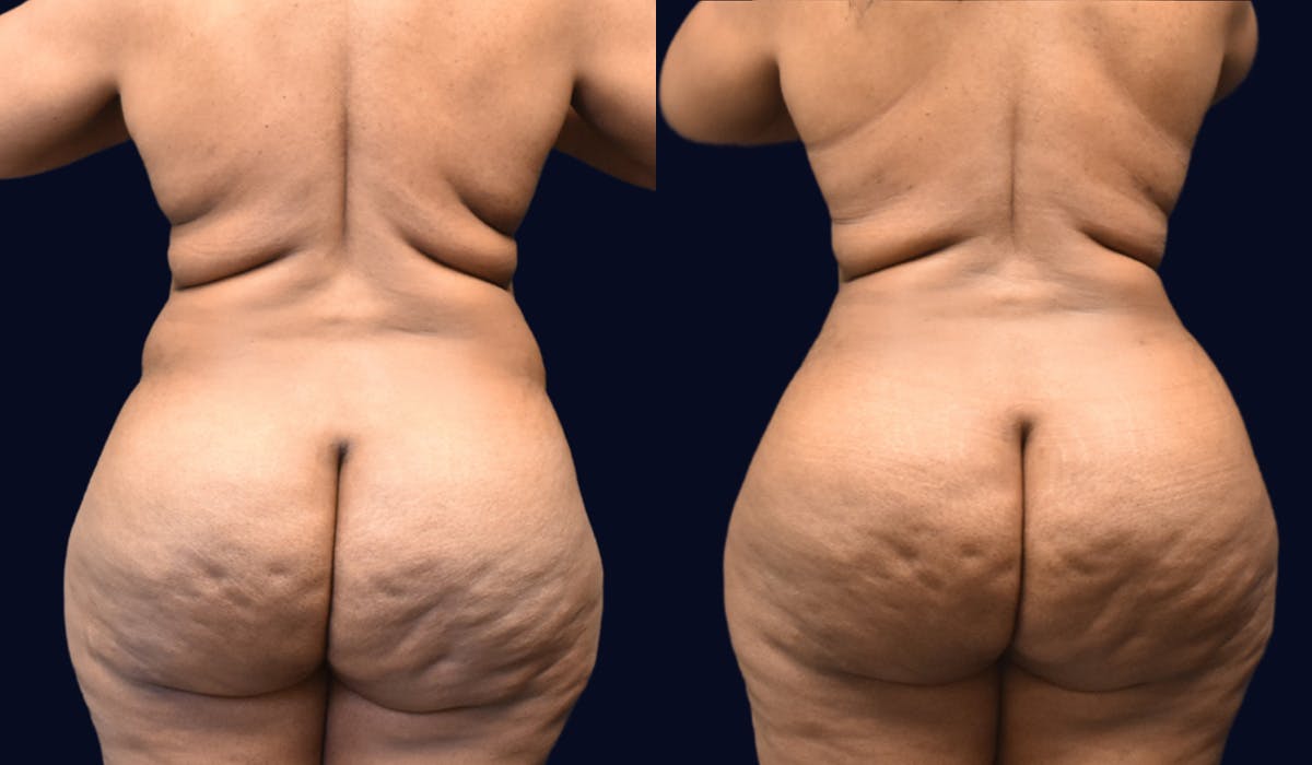 Abdominoplasty (Tummy Tuck) Before & After Gallery - Patient 101439 - Image 4