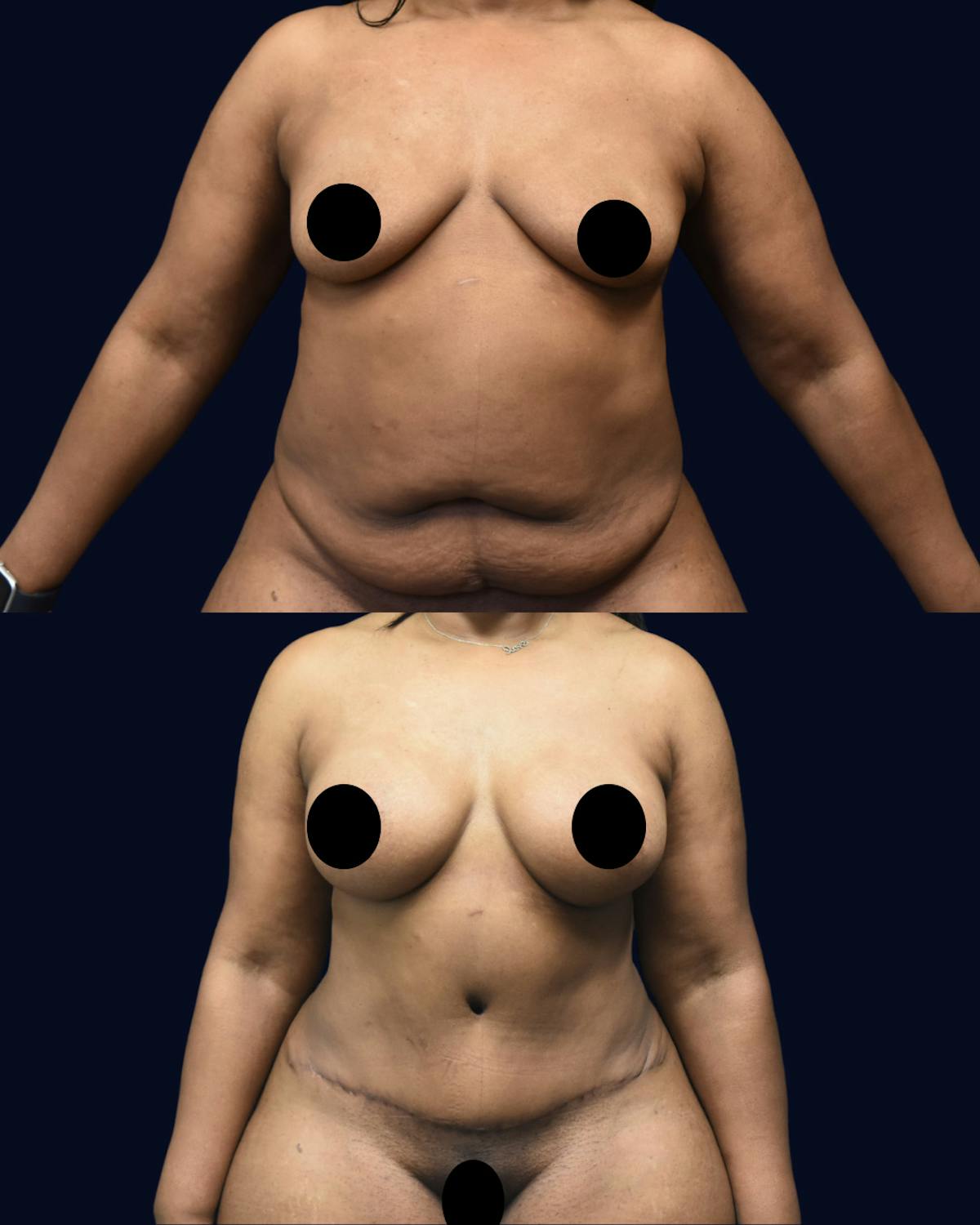 Breast Augmentation Before & After Gallery - Patient 386155 - Image 1