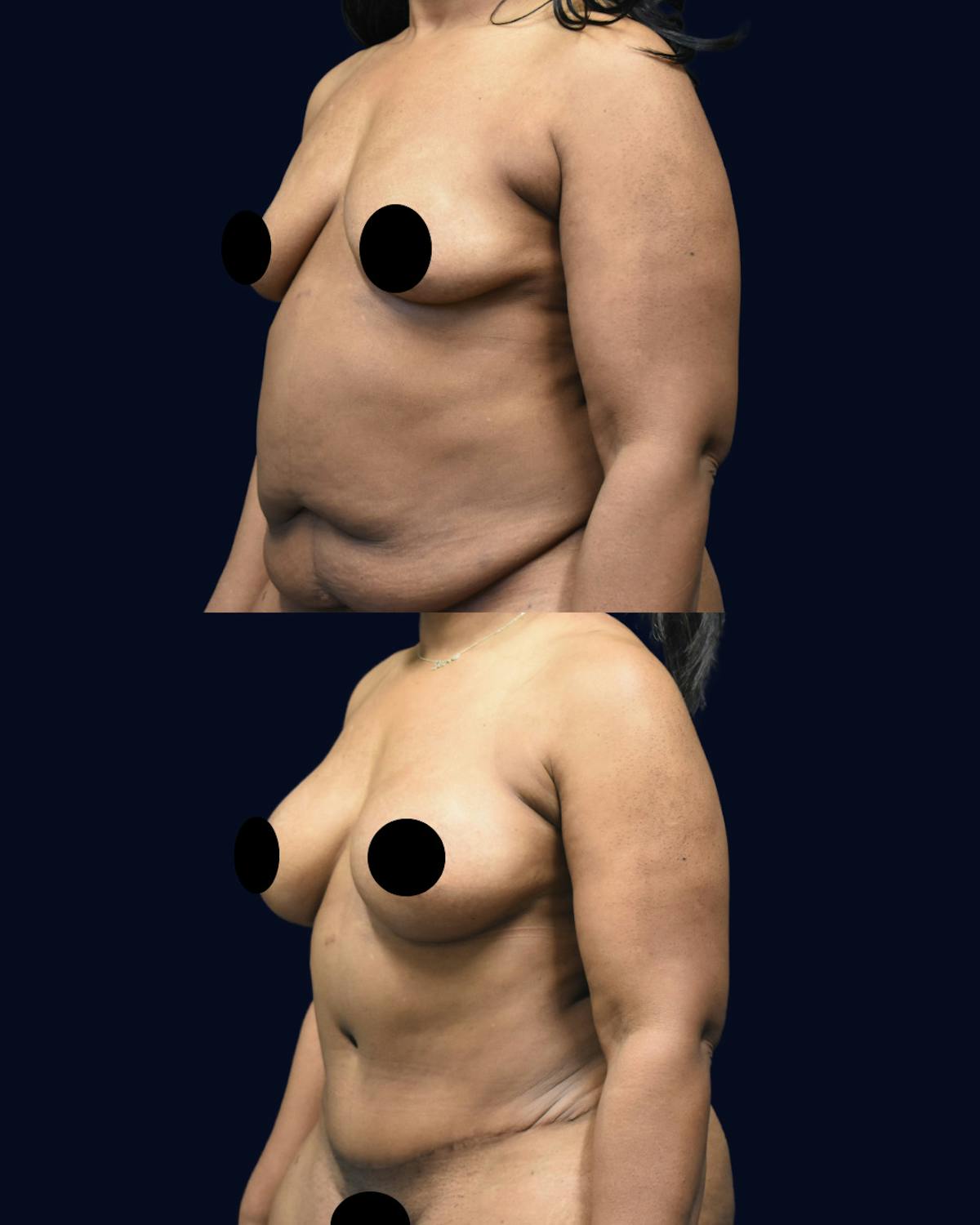 Breast Augmentation Before & After Gallery - Patient 386155 - Image 2