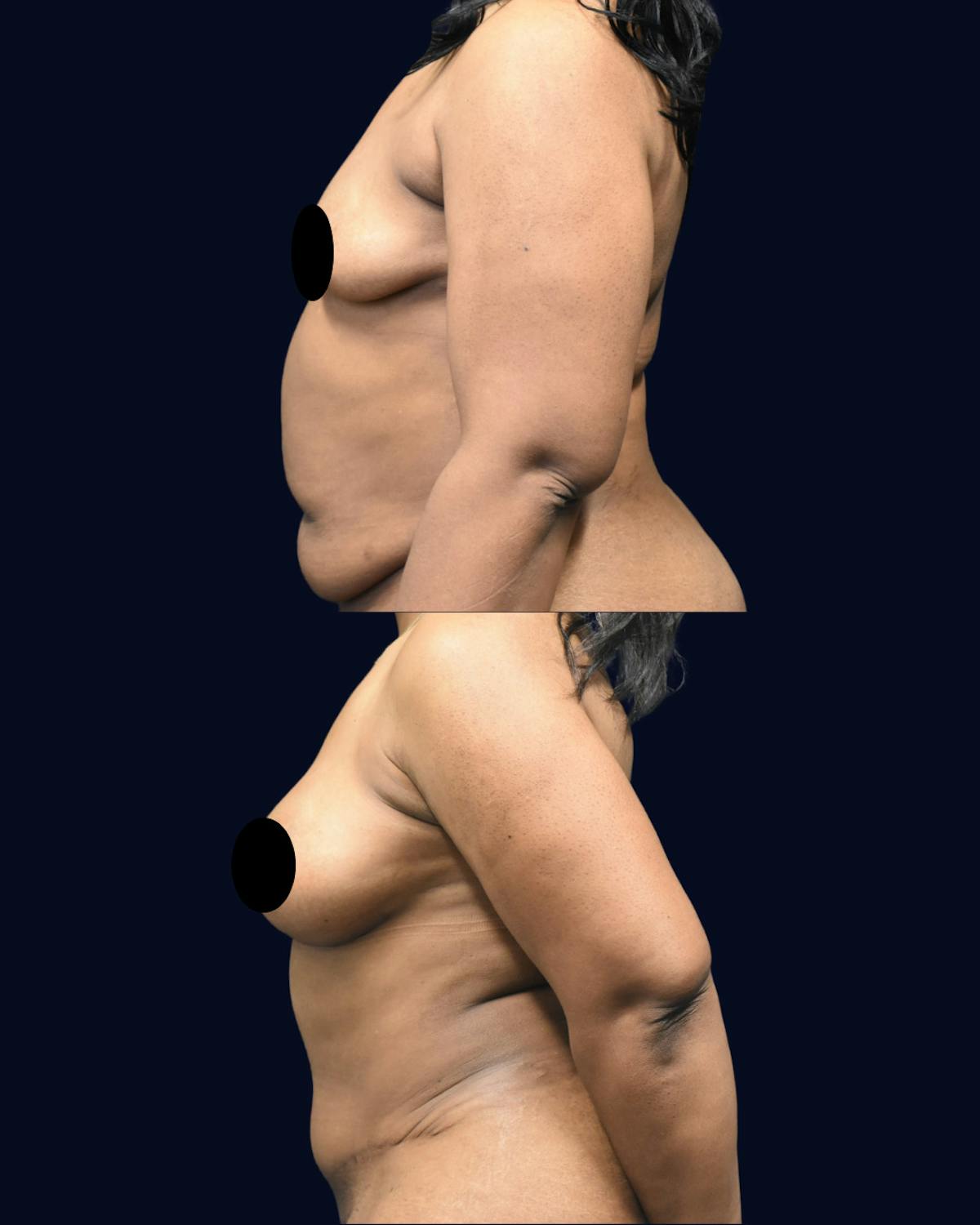 Breast Augmentation Before & After Gallery - Patient 386155 - Image 3