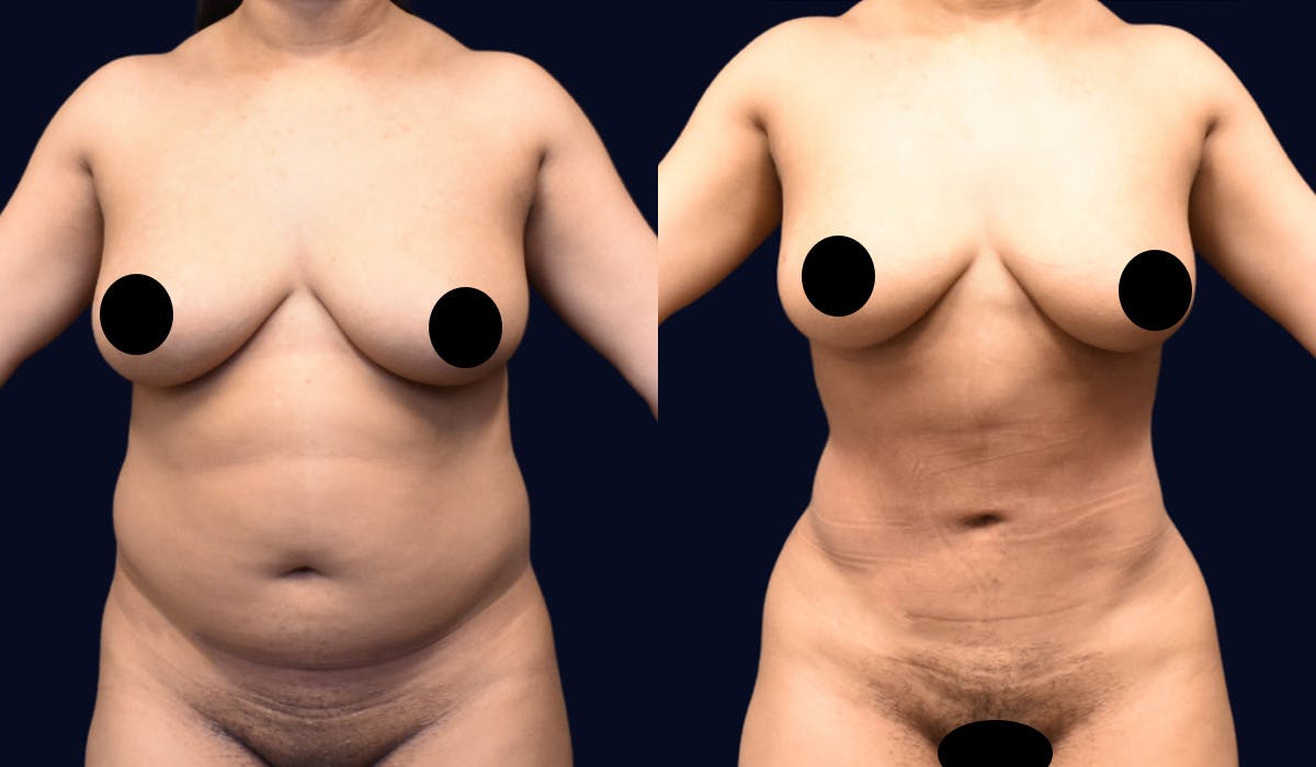 Liposuction Before & After Gallery - Patient 268789 - Image 1
