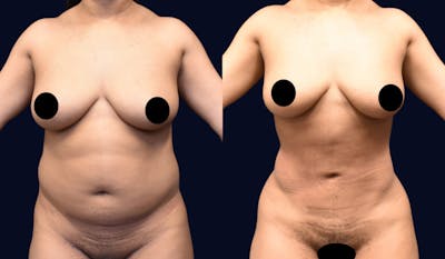 Liposuction Before & After Gallery - Patient 268789 - Image 1