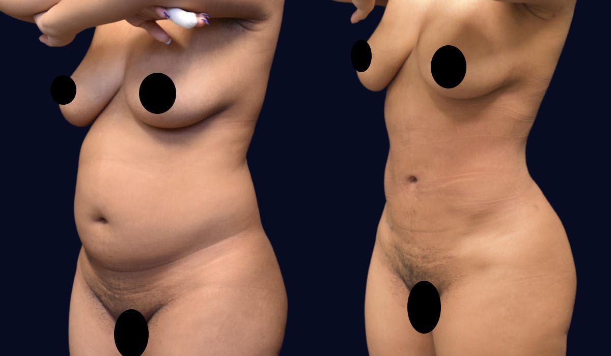 Liposuction Before & After Gallery - Patient 268789 - Image 2