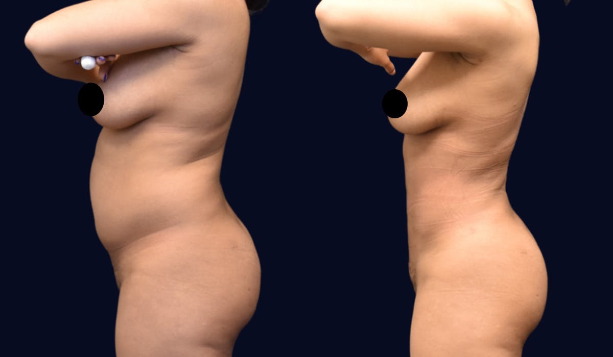 Liposuction Before & After Gallery - Patient 268789 - Image 3