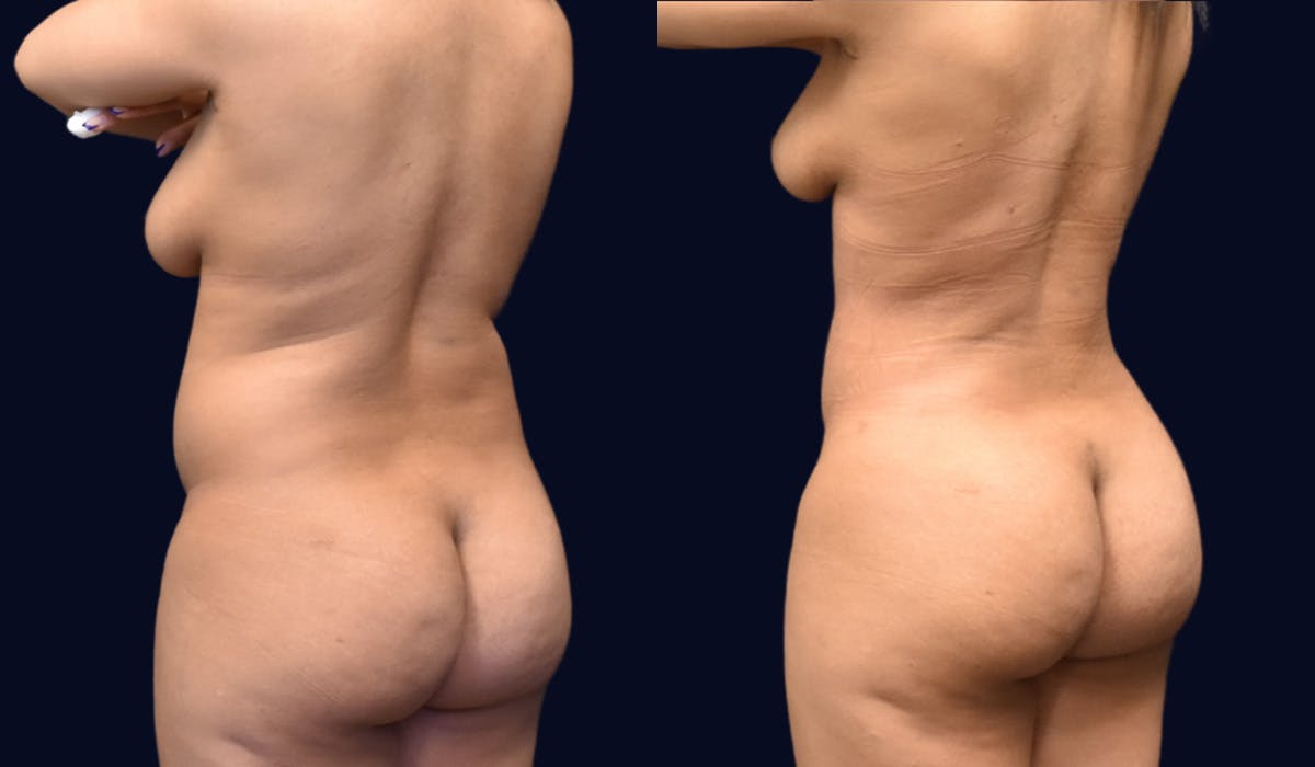 Liposuction Before & After Gallery - Patient 268789 - Image 4