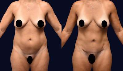 Liposuction Before & After Gallery - Patient 141516 - Image 1