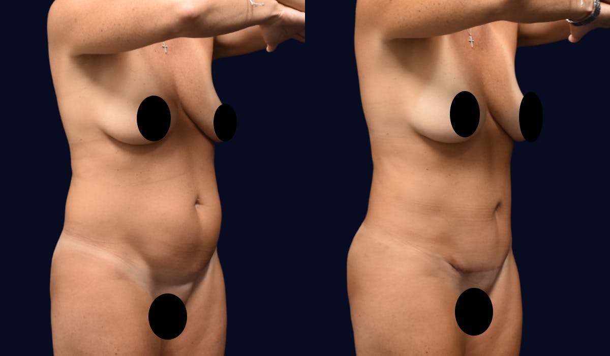 Liposuction Before & After Gallery - Patient 141516 - Image 2