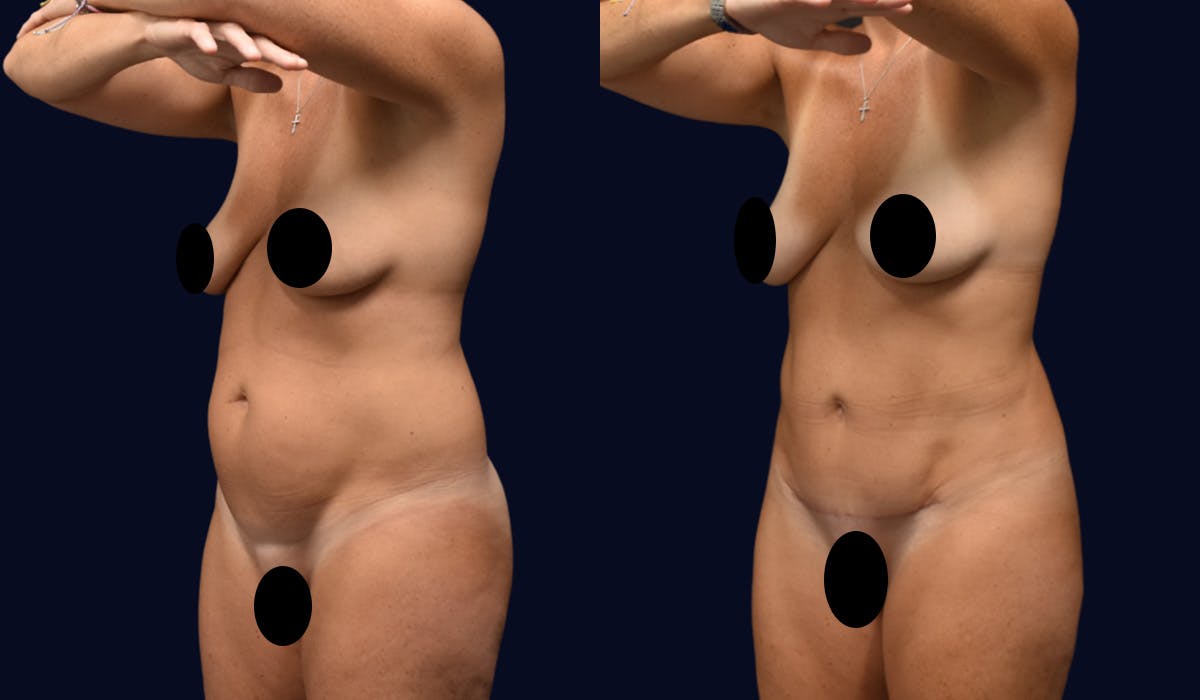 Liposuction Before & After Gallery - Patient 141516 - Image 3