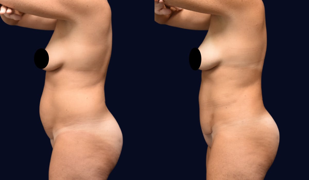 Liposuction Before & After Gallery - Patient 141516 - Image 4