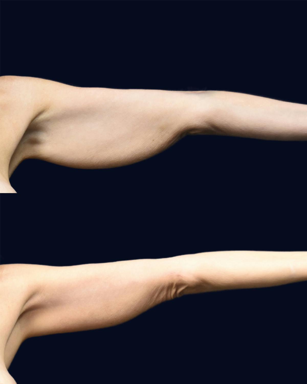 Brachioplasty (Arm Lift) Before & After Gallery - Patient 397318 - Image 1
