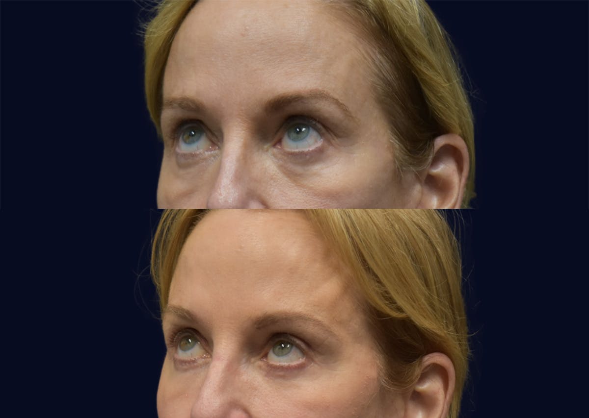 Blepharoplasty (Eyelid Surgery) Before & After Gallery - Patient 324403 - Image 2